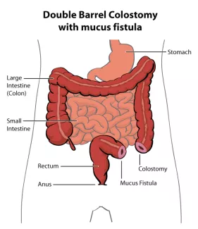 Double barrel colostomy with mucus fistula